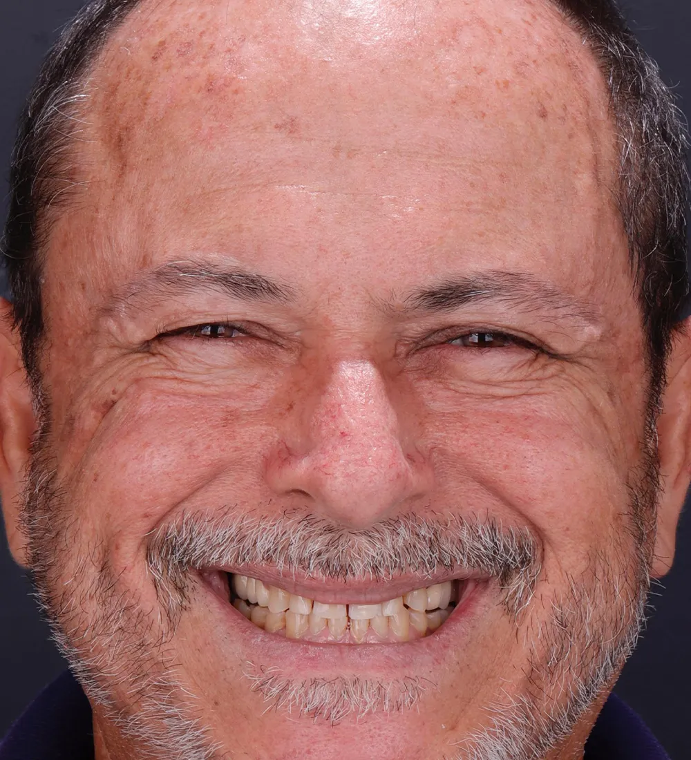 Antes - Transformação 4