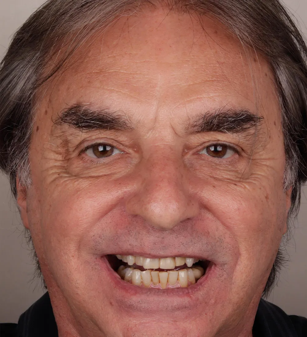 Antes - Transformação 5